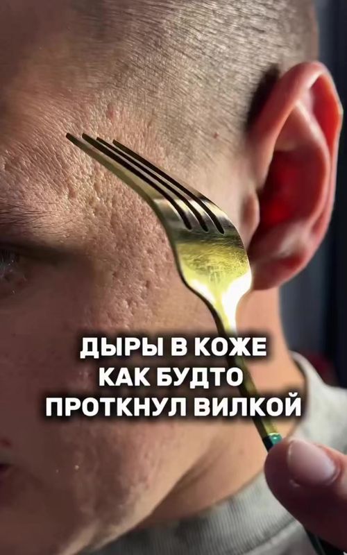 Как преобразить проблемную кожу: результаты после ретинола